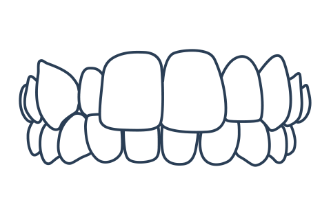 Crossbite example for Invisalign